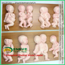 VERKAUFEN Sie 12452 Demonstrator Deformities in Kleinkinder, 8 Stück in einer Serie, Anatomie Modelle&gt; Fetal Malformation Model